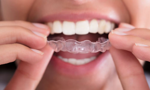 Clear Aligners Invisalign Spark Clear Aligners Carol Stream, Glendale Heights, Bloomingdale, Keeneyville - All About Yue Orthodontics