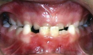 Underbite