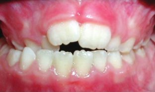 Posterior Crossbite
