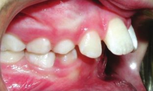 Protrusion