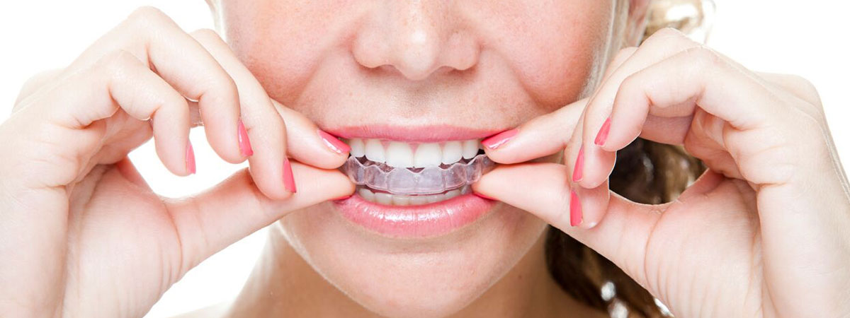 Clear Aligners