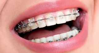 Clear Braces Carol Stream, Glendale Heights, Bloomingdale, Keeneyville All About Yue Orthodontist