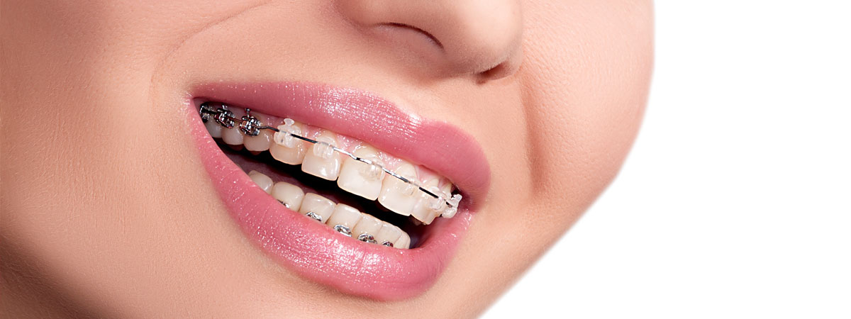 Clear Braces
