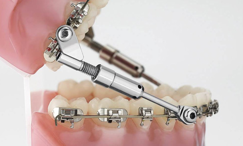 Surgical Orthodontics All About Yue