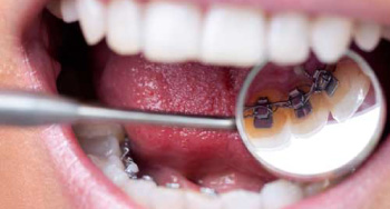 Lingual Braces Carol Stream, Glendale Heights, Bloomingdale, Keeneyville All About Yue Orthodontist