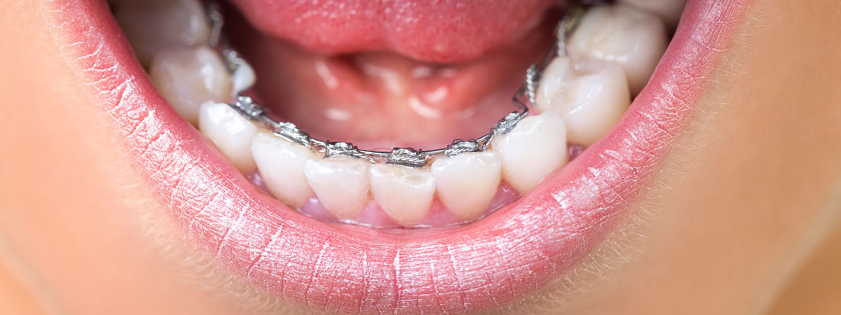 Lingual Braces