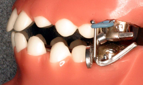 Surgical Orthodontics All About Yue