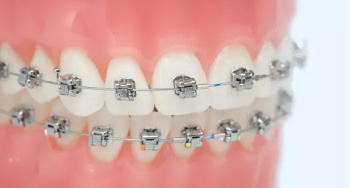 Carol Stream, Glendale Heights, Bloomingdale, Keeneyville self ligating metal bracket from Damon ultima