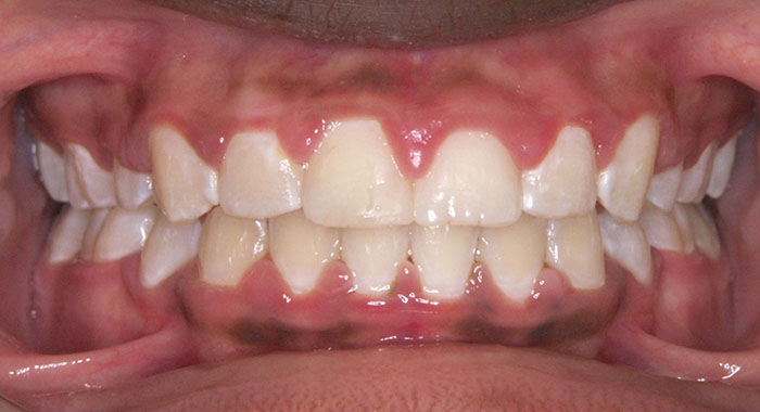 Orthodontist Invisalign Spark Braces Carol Stream, Glendale Heights, Bloomingdale, Keeneyville All About Yue Orthodontics