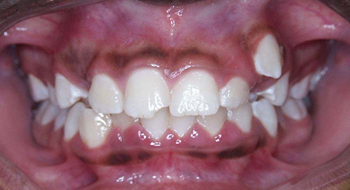 Orthodontist Invisalign Spark Braces Carol Stream, Glendale Heights, Bloomingdale, Keeneyville All About Yue Orthodontics