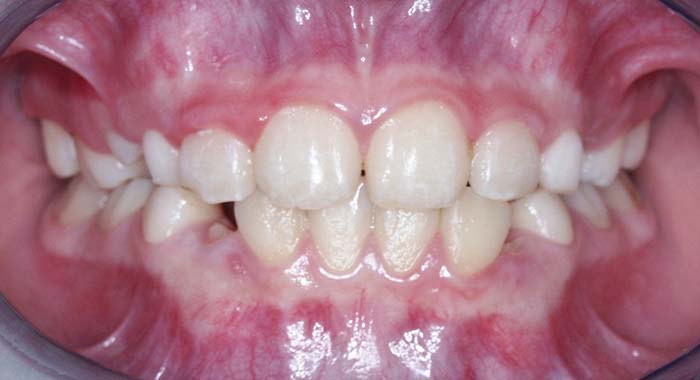 Orthodontist Invisalign Spark Braces Carol Stream, Glendale Heights, Bloomingdale, Keeneyville All About Yue Orthodontics