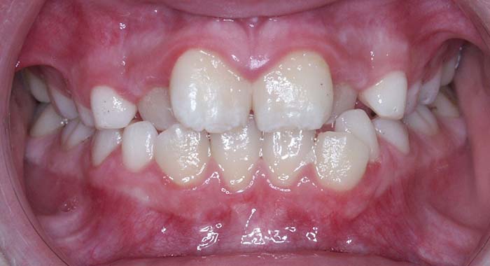 Orthodontist Invisalign Spark Braces Carol Stream, Glendale Heights, Bloomingdale, Keeneyville All About Yue Orthodontics
