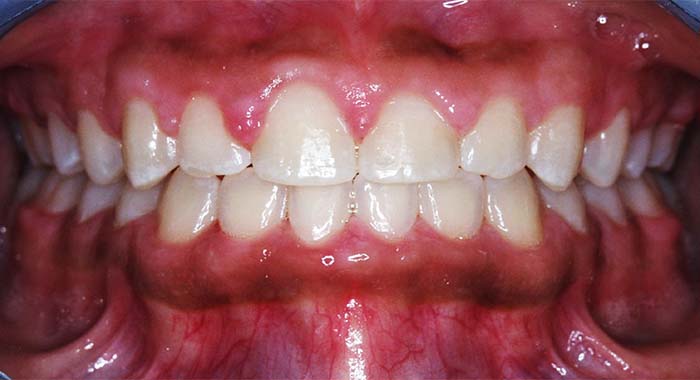 Orthodontist Invisalign Spark Braces Carol Stream, Glendale Heights, Bloomingdale, Keeneyville All About Yue Orthodontics