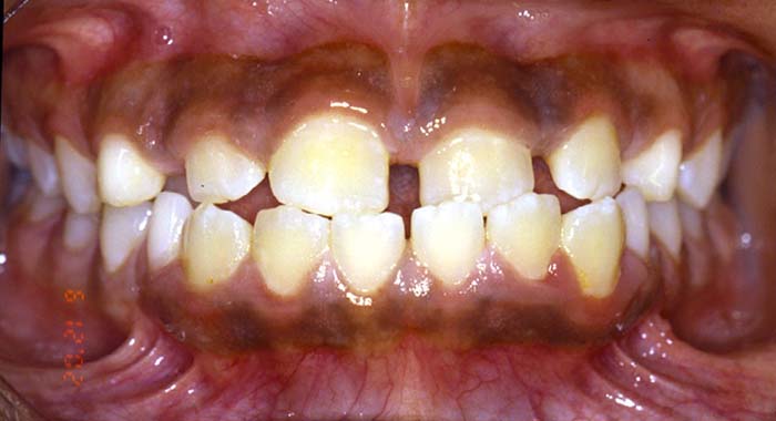 Orthodontist Invisalign Spark Braces Carol Stream, Glendale Heights, Bloomingdale, Keeneyville All About Yue Orthodontics