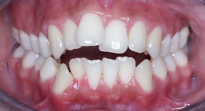 Orthodontist Invisalign Spark Braces Carol Stream, Glendale Heights, Bloomingdale, Keeneyville All About Yue Orthodontics