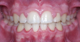 Orthodontist Invisalign Spark Braces Carol Stream, Glendale Heights, Bloomingdale, Keeneyville All About Yue Orthodontics