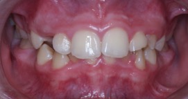 Orthodontist Invisalign Spark Braces Carol Stream, Glendale Heights, Bloomingdale, Keeneyville All About Yue Orthodontics