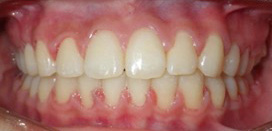 Orthodontist Invisalign Spark Braces Carol Stream, Glendale Heights, Bloomingdale, Keeneyville All About Yue Orthodontics