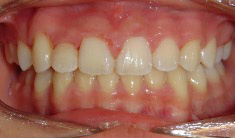 Orthodontist Invisalign Spark Braces Carol Stream, Glendale Heights, Bloomingdale, Keeneyville All About Yue Orthodontics