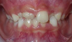 Orthodontist Invisalign Spark Braces Carol Stream, Glendale Heights, Bloomingdale, Keeneyville All About Yue Orthodontics