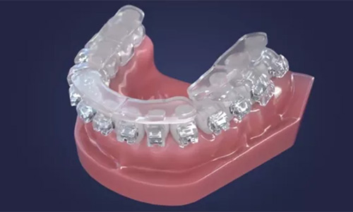 Ormco Digital Bonding