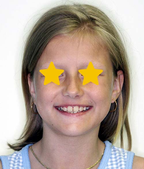 Orthodontist Invisalign Spark Braces Carol Stream, Glendale Heights, Bloomingdale, Keeneyville All About Yue Orthodontics
