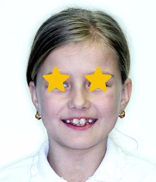 Orthodontist Invisalign Spark Braces Carol Stream, Glendale Heights, Bloomingdale, Keeneyville All About Yue Orthodontics
