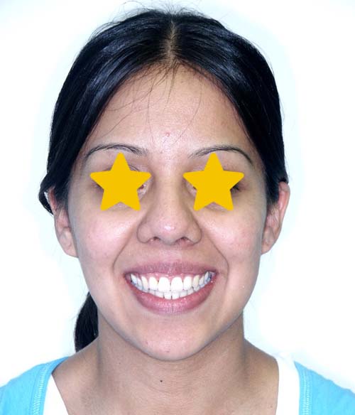 Orthodontist Invisalign Spark Braces Carol Stream, Glendale Heights, Bloomingdale, Keeneyville All About Yue Orthodontics