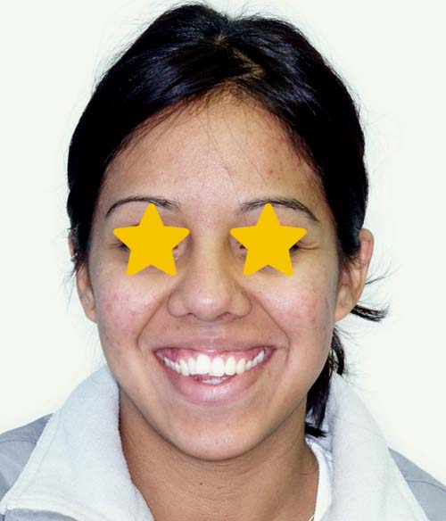 Orthodontist Invisalign Spark Braces Carol Stream, Glendale Heights, Bloomingdale, Keeneyville All About Yue Orthodontics