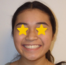Orthodontist Invisalign Spark Braces Carol Stream, Glendale Heights, Bloomingdale, Keeneyville All About Yue Orthodontics