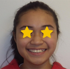 Orthodontist Invisalign Spark Braces Carol Stream, Glendale Heights, Bloomingdale, Keeneyville All About Yue Orthodontics