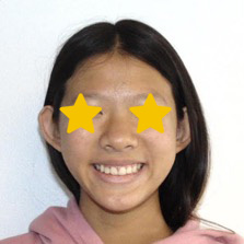 Orthodontist Invisalign Spark Braces Carol Stream, Glendale Heights, Bloomingdale, Keeneyville All About Yue Orthodontics