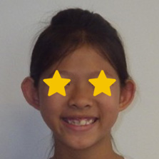 Orthodontist Invisalign Spark Braces Carol Stream, Glendale Heights, Bloomingdale, Keeneyville All About Yue Orthodontics